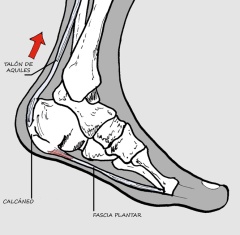 Un acortamiento del tendón de Aquiles provoca un estrés en la fascia